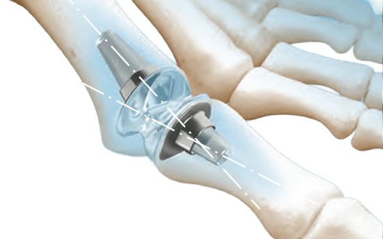 RTS First_Broachless Implantation