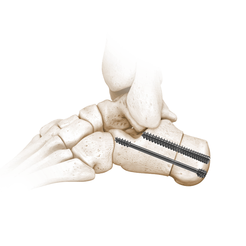 I.B.S.™ Compression Screws