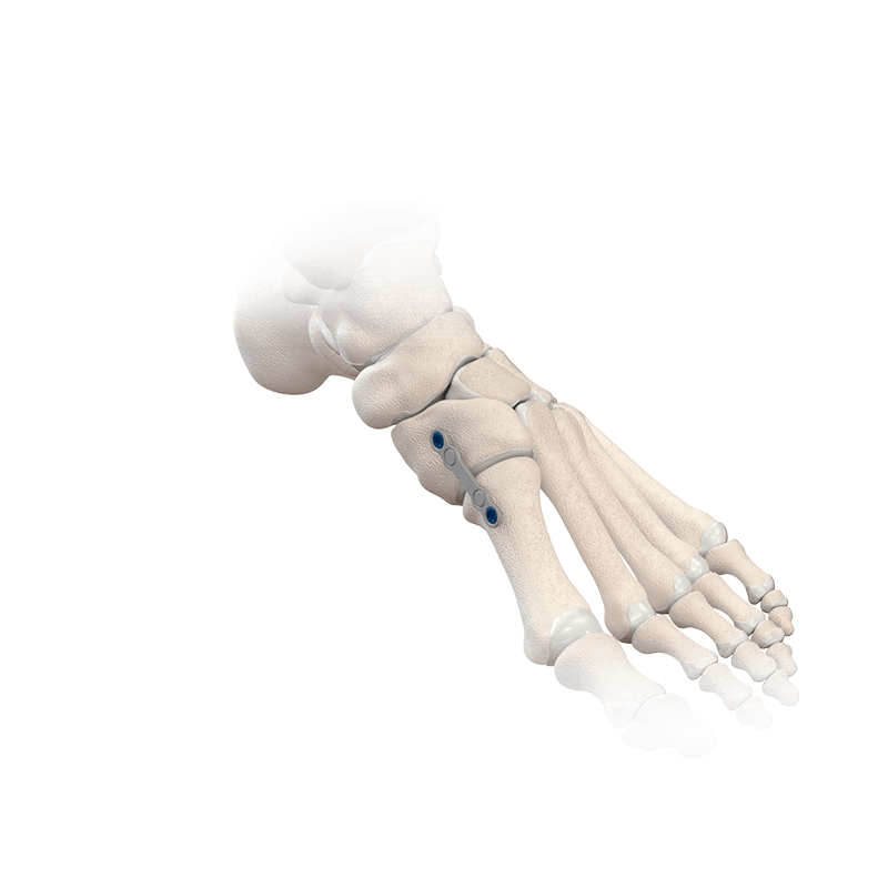 NeoSpan<sup>®</sup> Compression Implant System
