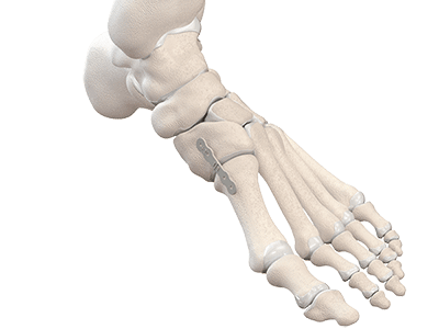 Animation of the NeoSpan system