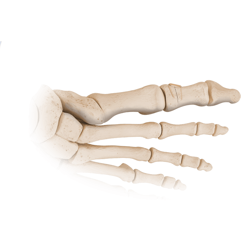 OS2-VP™ Compression Staples