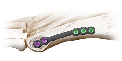 animation of bunionette plate screwed in place on bone