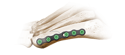 5ms lateral neck plate