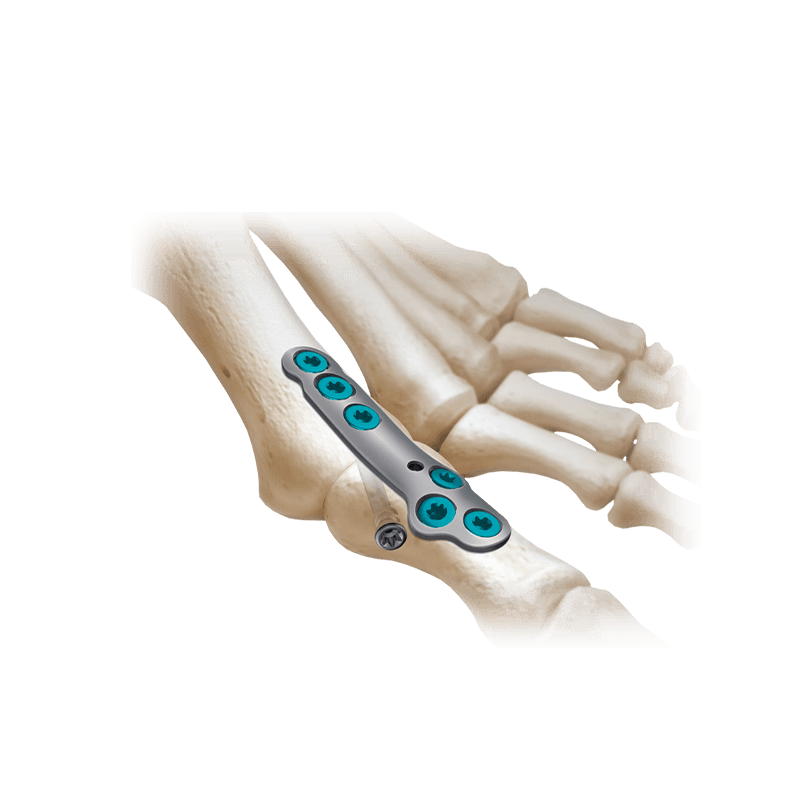 CoLink<sup>®</sup>2 Compression Plating System