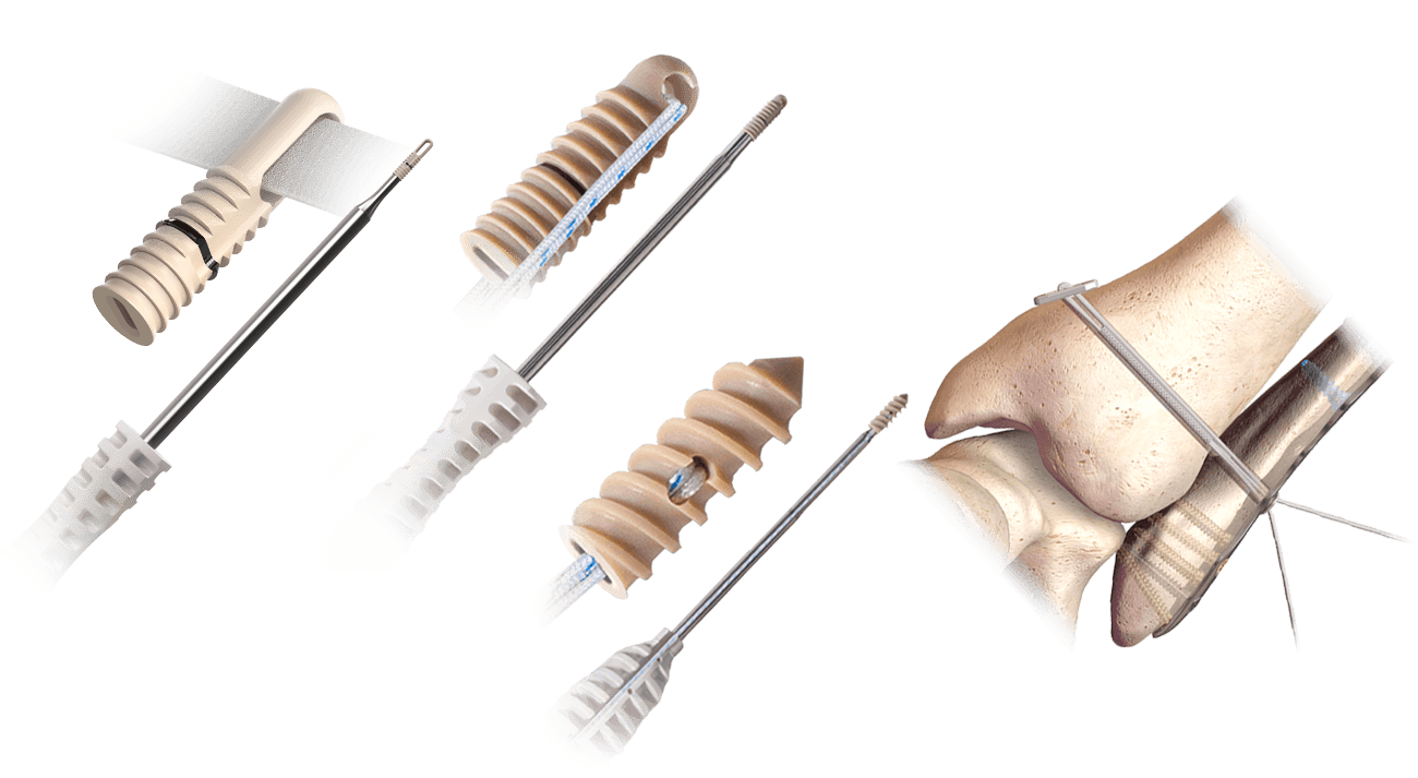 Hercules-Produktkollektion: FT mit Vollgewinde, FT ohne Knoten, knotenloses Syndesmosesystem und XE