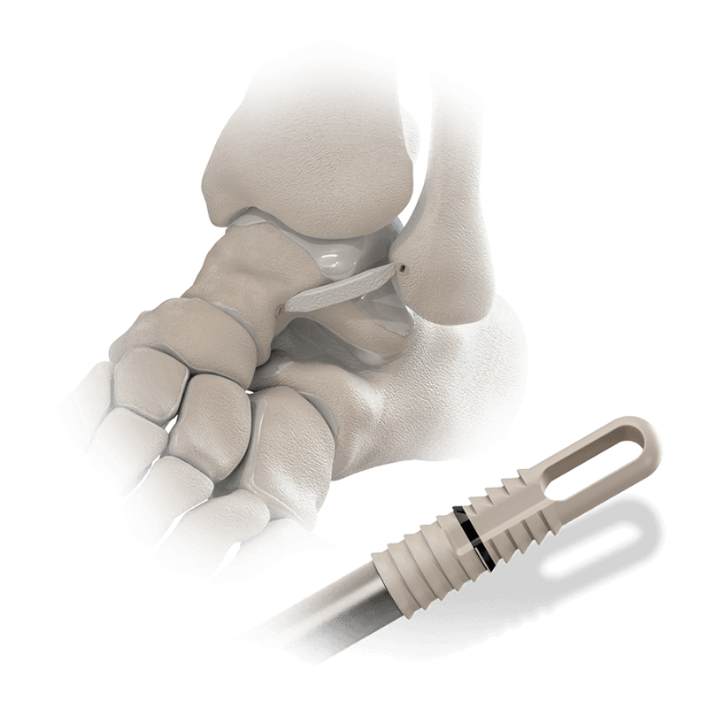 Hercules<sup>®</sup> XE Knotless Suture Anchor