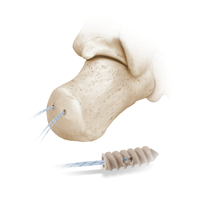 Hercules<sup>®</sup> Fully Threaded Suture Anchor