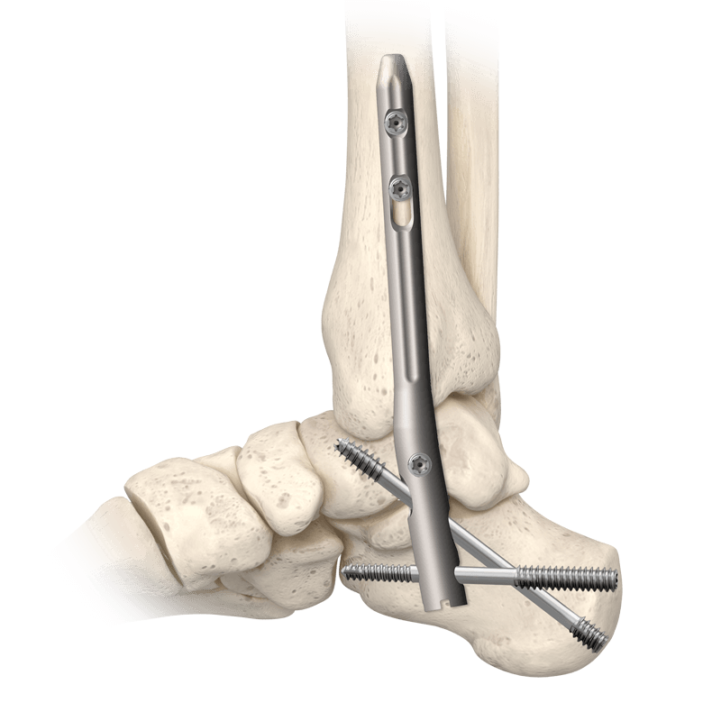 TriWay<sup>®</sup> Ankle Fusion Nail