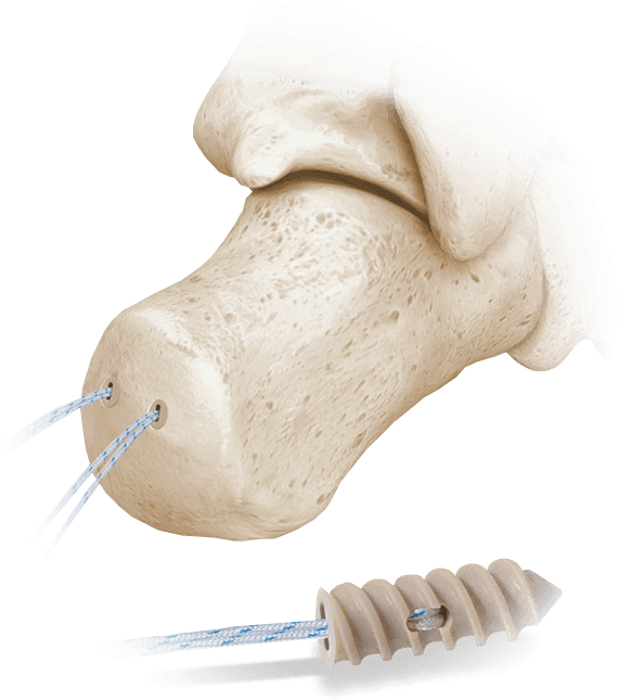 Hercules FT Vollgewindediagramm