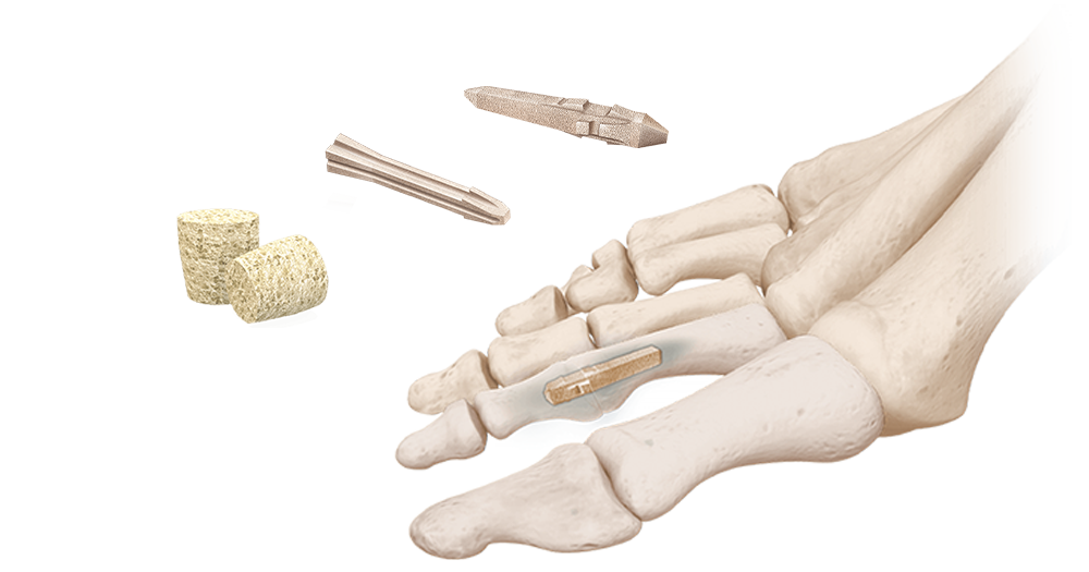 Allograft Implants
