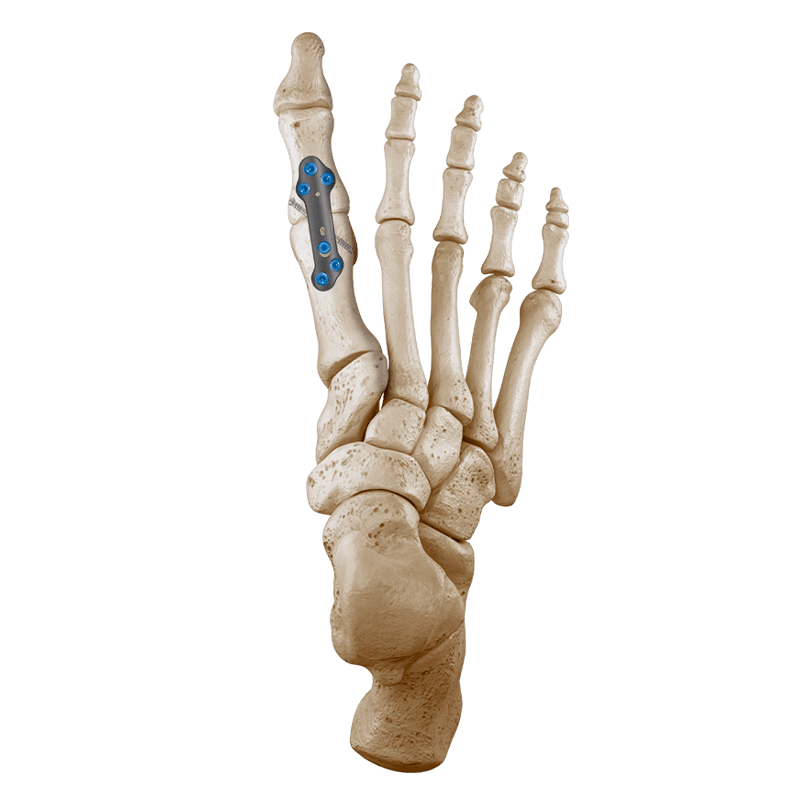 CoLink® NX MTP Compression Plating System