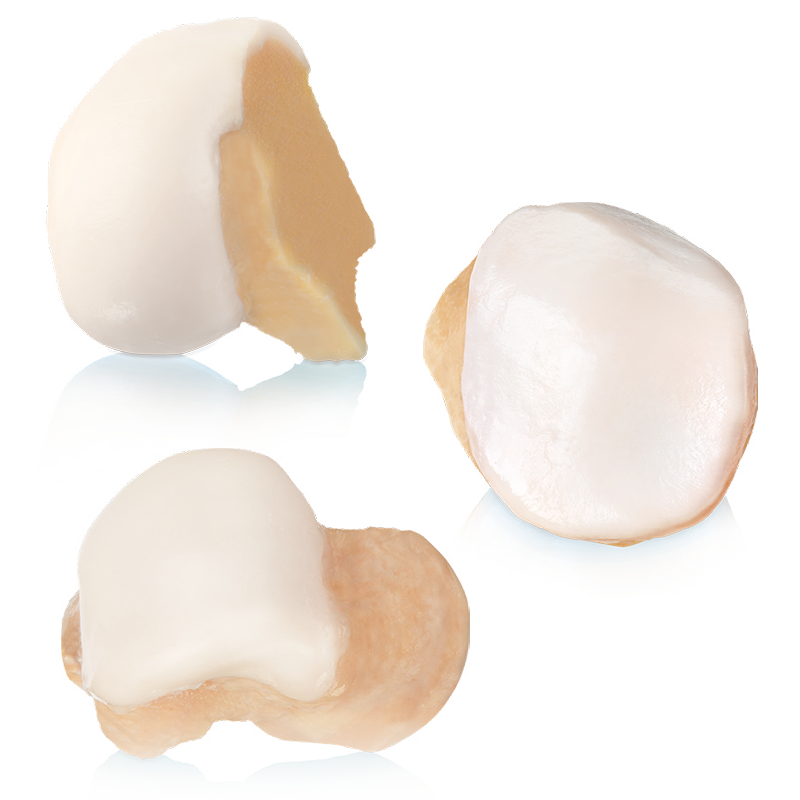Osteochondral Allografts