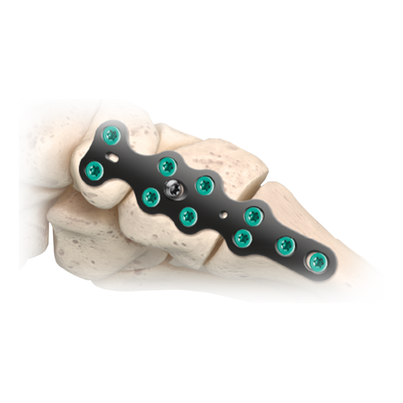 CoLink Mfx Midfoot Plating System