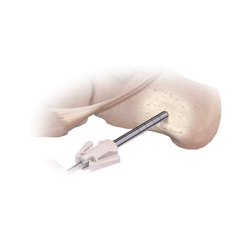 CoLink® Bone Graft Harvester