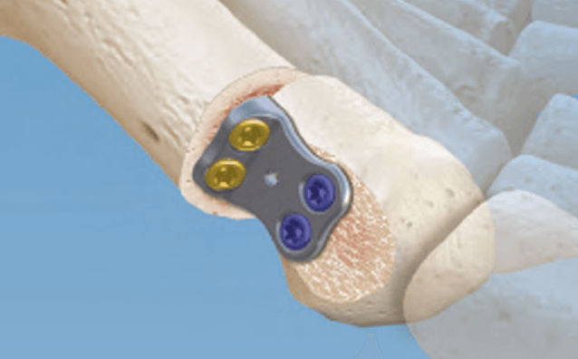 Active Bunion Procedure Using the CoLink Vallux Plating System