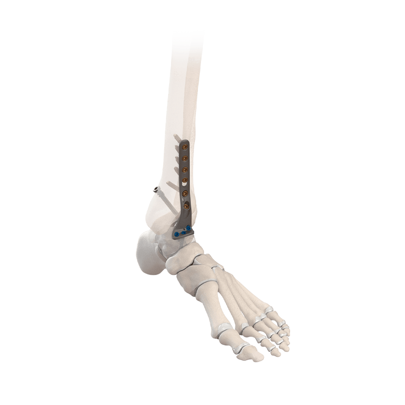 CoLink® NeoFuse Ankle Fusion Plating System