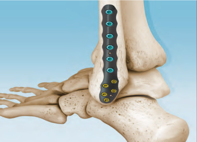 Ankle Fracture Plating Technique Using the CoLink Afx Plating Syste